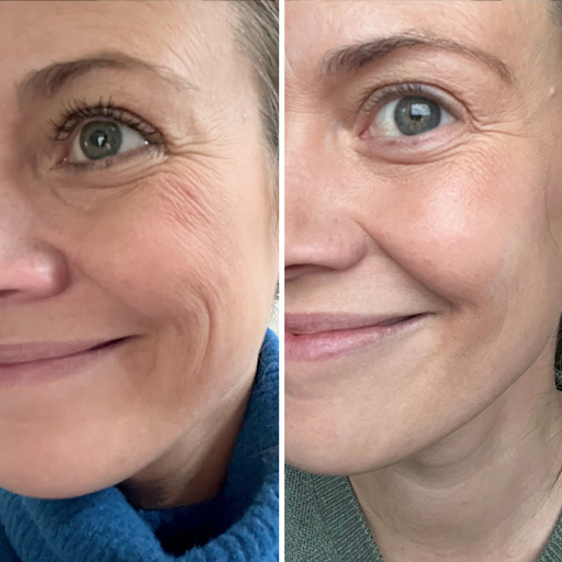 Kvinna 40 år före och efter kollagenpulver från Oslo Skin Lab